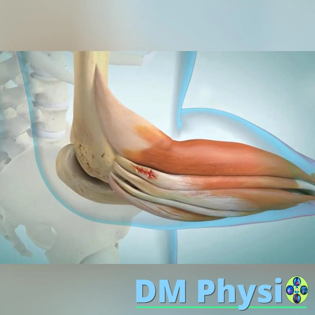 Анатомия на тенис лакът